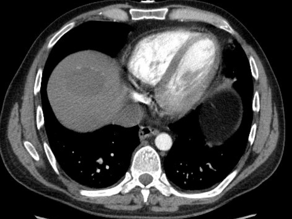 ultrasound elastography image from Deep Health® Device showing thickening of pericardium