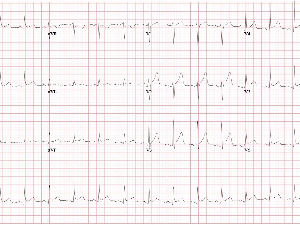 ECG Result of the person flagged by the Deep Health® Device AI system confirming acute pericarditis